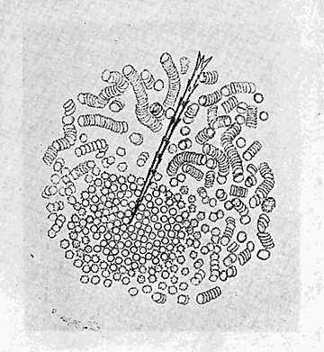 37. (b) Effect of the poison on the blood corpuscles
of man. After Tyzzer.