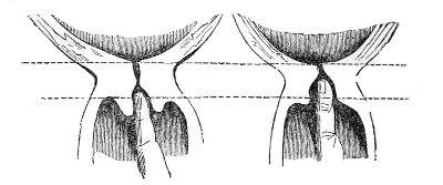 neck of
the Womb