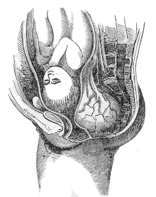 Case of
Tumor