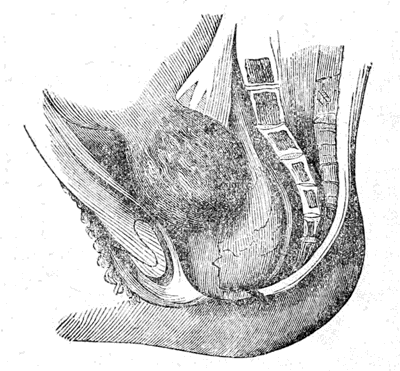 Case of
Polypus